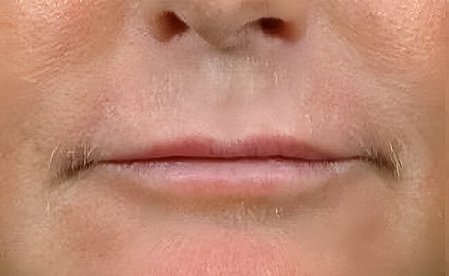 Fillers before treatment – Murrieta Facial Plastic Surgery, case 2