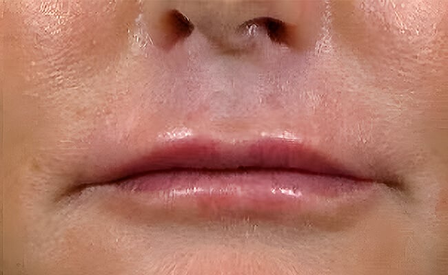 Fillers after treatment – Murrieta Facial Plastic Surgery, case 2