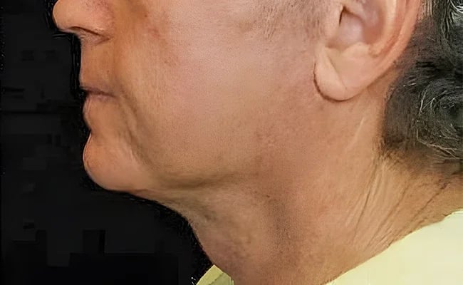 Facelift after surgery – Murrieta Facial Plastic Surgery, case 13