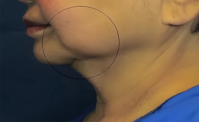 Facelift before surgery – Murrieta Facial Plastic Surgery, case 27