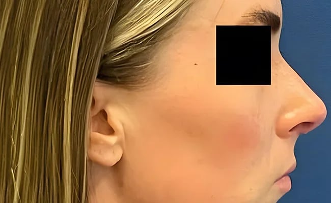 Rhinoplasty after surgery – Murrieta Facial Plastic Surgery, case 2