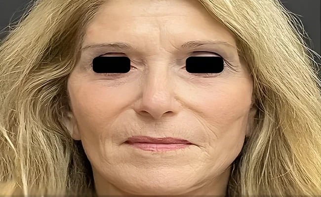 Facelift after surgery – Murrieta Facial Plastic Surgery, case 4
