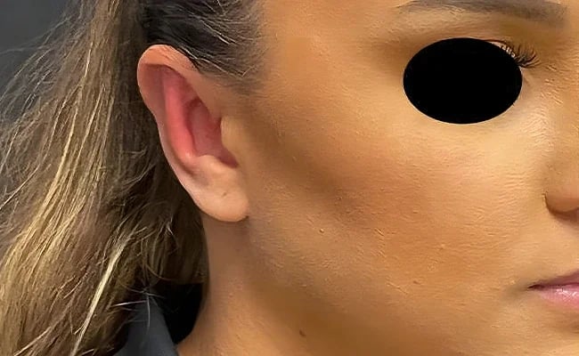 Ear Surgery after surgery – Murrieta Facial Plastic Surgery, case 1