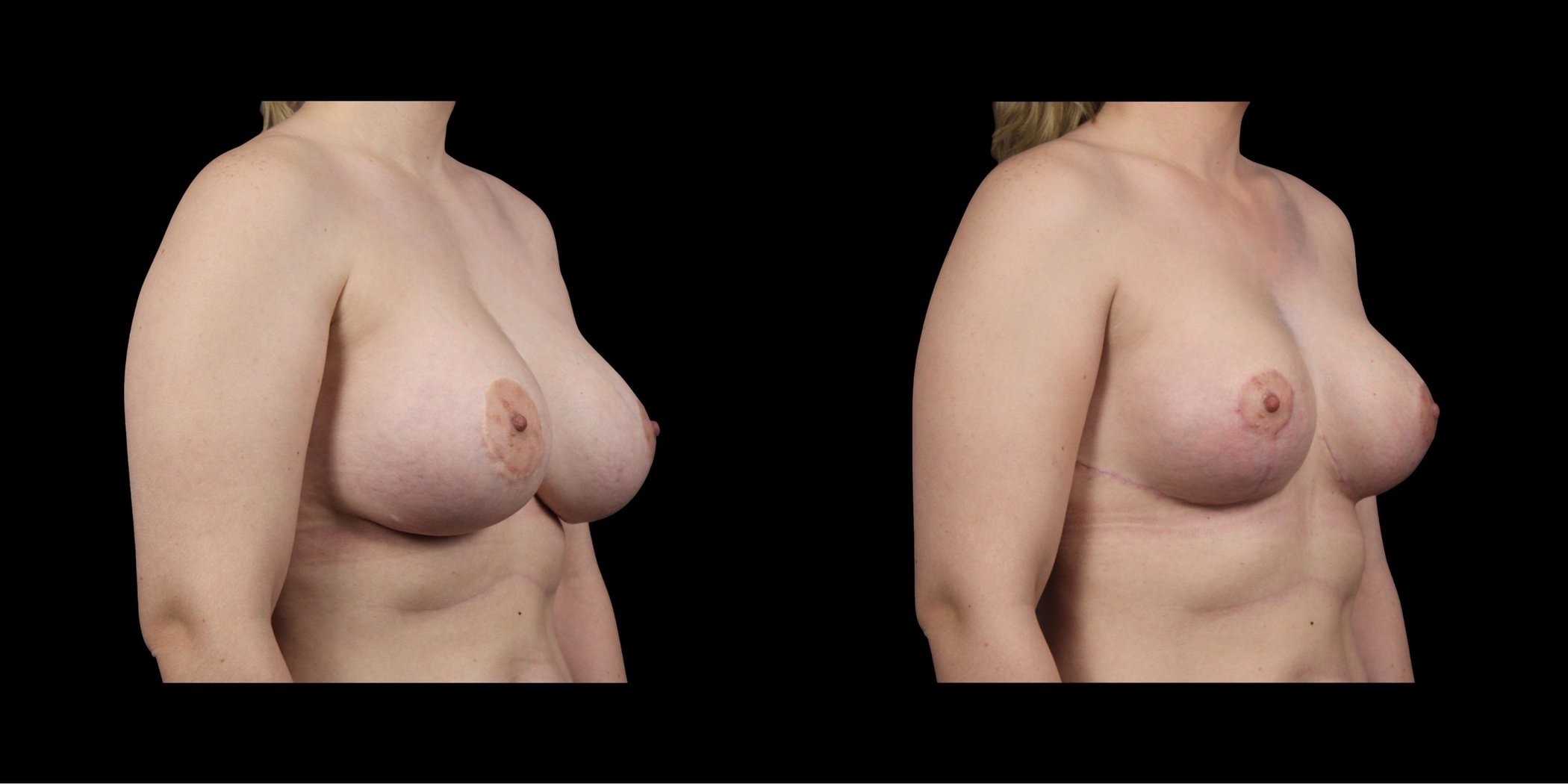Augmentation Mastopexy before-and-after composite, Consona Plastic Surgery – case 3, view 2
