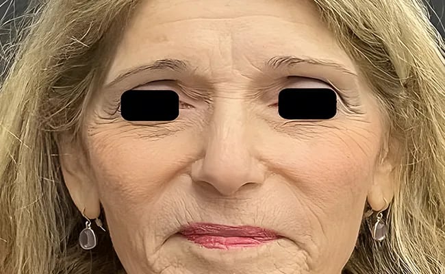 Brow Lift before surgery – Murrieta Facial Plastic Surgery, case 6