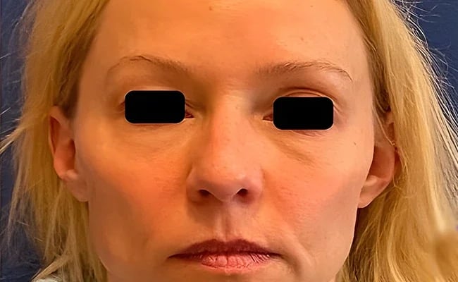 Rhinoplasty before surgery – Murrieta Facial Plastic Surgery, case 5