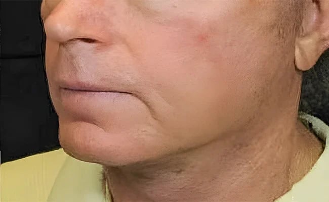 Facelift after surgery – Murrieta Facial Plastic Surgery, case 12