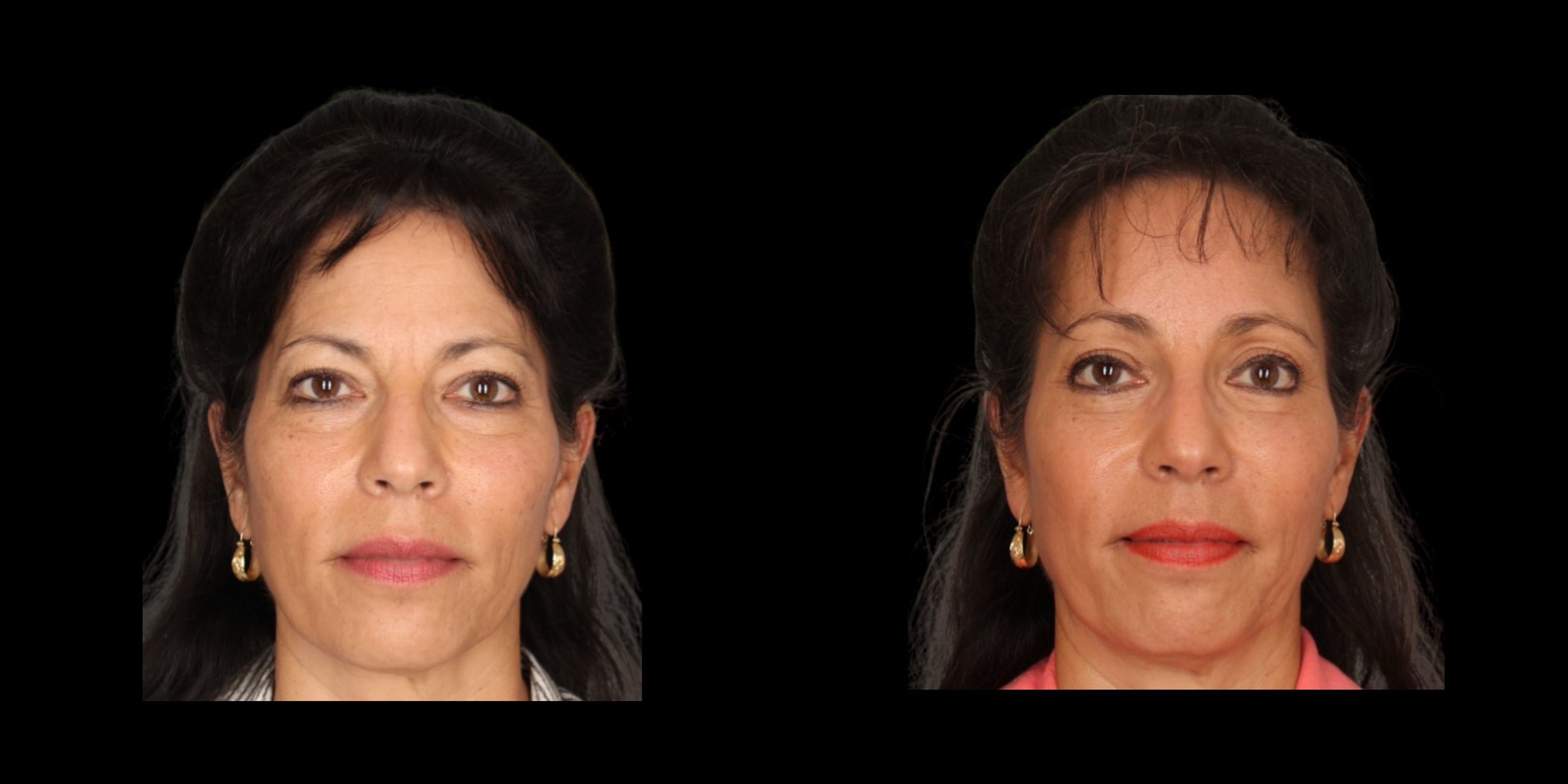 Blepharoplasty before-and-after composite, Consona Plastic Surgery – case 5, view 1
