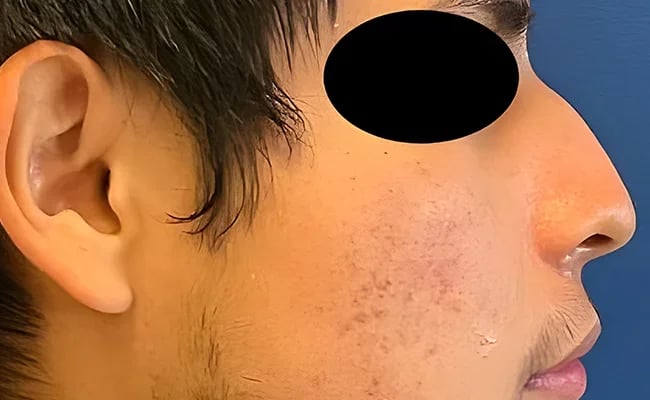 Rhinoplasty before surgery – Murrieta Facial Plastic Surgery, case 11