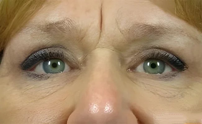 Eyelid Surgery after surgery – Murrieta Facial Plastic Surgery, case 21