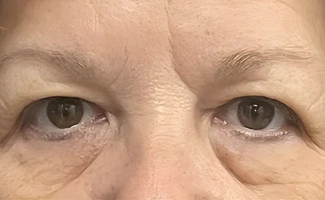Eyelid Surgery before surgery – Murrieta Facial Plastic Surgery, case 3