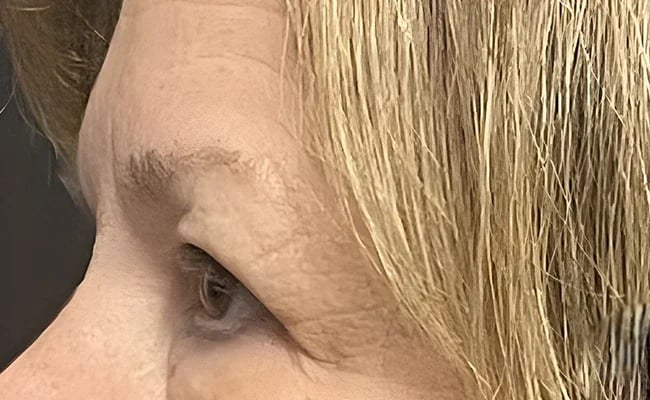 Eyelid Surgery before surgery – Murrieta Facial Plastic Surgery, case 4