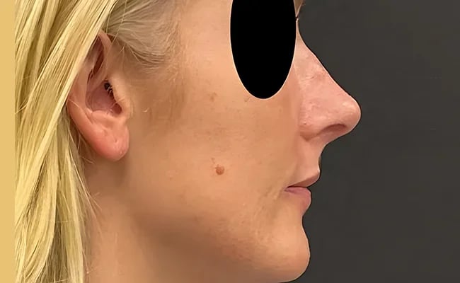 Rhinoplasty after surgery – Murrieta Facial Plastic Surgery, case 14