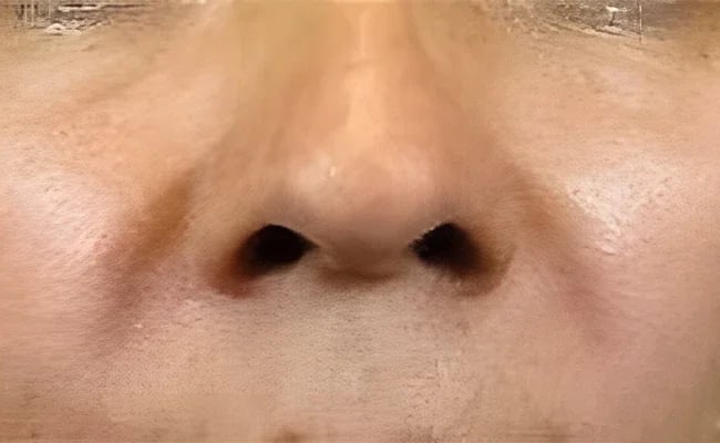 Facial Fat Grafting after surgery – Murrieta Facial Plastic Surgery, case 1