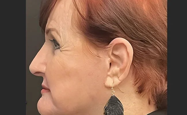 Facelift after surgery – Murrieta Facial Plastic Surgery, case 25