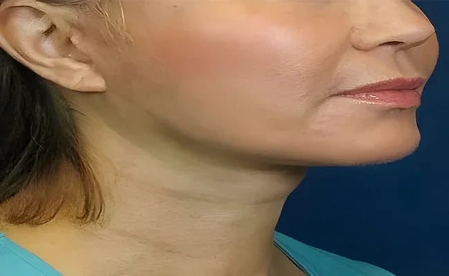 Facelift after surgery – Murrieta Facial Plastic Surgery, case 1