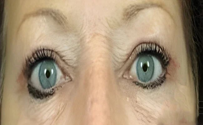 Eyelid Surgery after surgery – Murrieta Facial Plastic Surgery, case 20