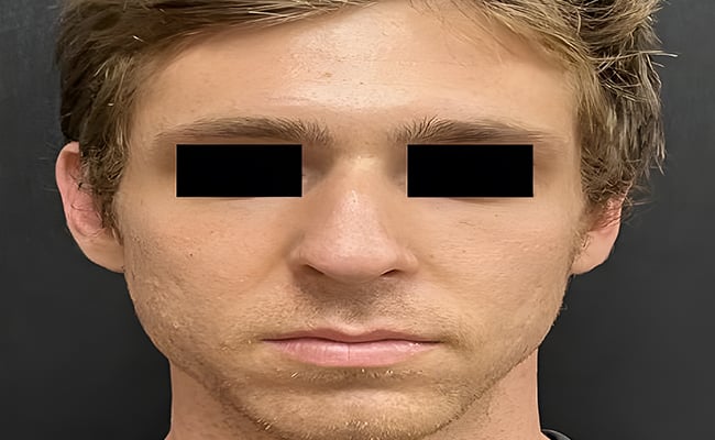 Rhinoplasty after surgery – Murrieta Facial Plastic Surgery, case 15
