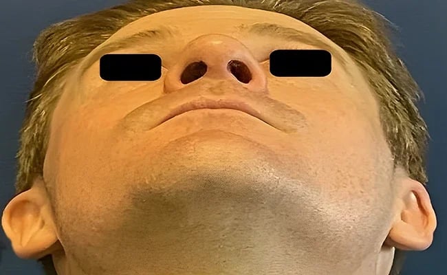 Rhinoplasty after surgery – Murrieta Facial Plastic Surgery, case 4