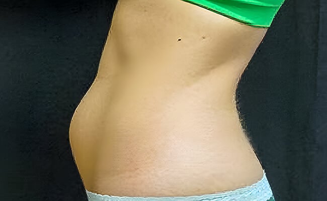 Liposuction before surgery – Murrieta Facial Plastic Surgery, case 4