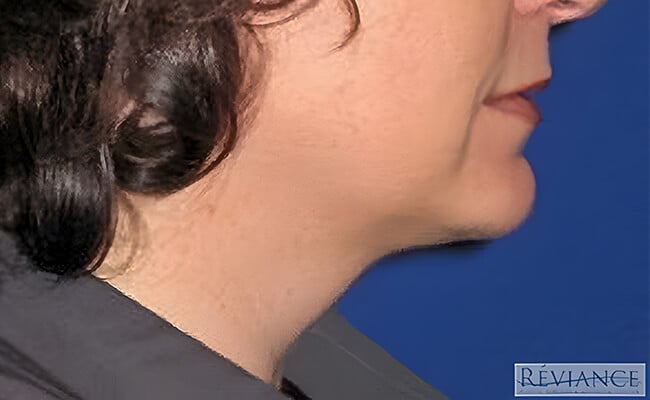 Neck Lift after surgery – Murrieta Facial Plastic Surgery, case 6