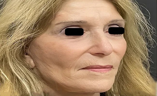 Facelift after surgery – Murrieta Facial Plastic Surgery, case 5