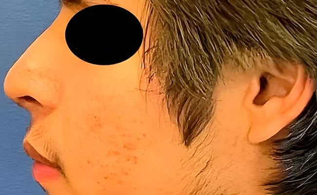 Rhinoplasty after surgery – Murrieta Facial Plastic Surgery, case 12