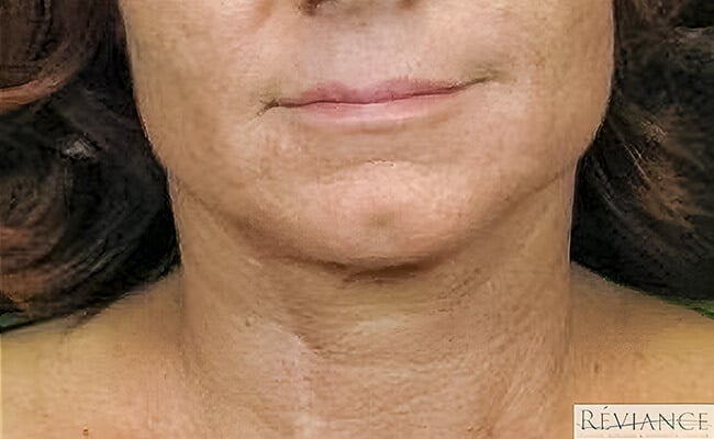 Neck Lift after surgery – Murrieta Facial Plastic Surgery, case 3