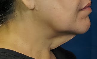 Neck Lift before surgery – Murrieta Facial Plastic Surgery, case 1