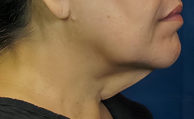 Neck Lift before surgery – Murrieta Facial Plastic Surgery, case 1