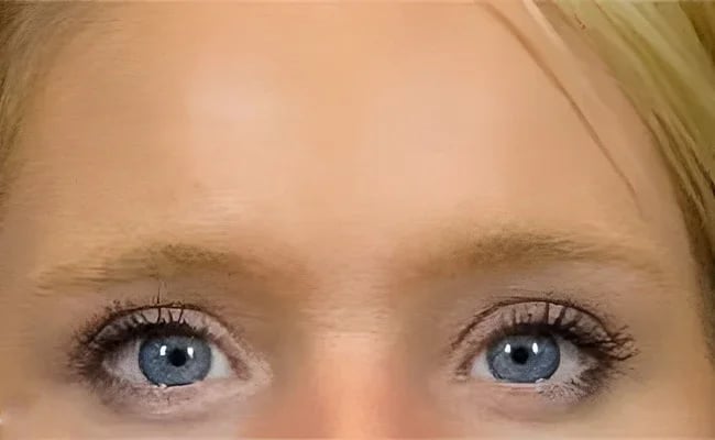 Brow Lift before surgery – Murrieta Facial Plastic Surgery, case 5