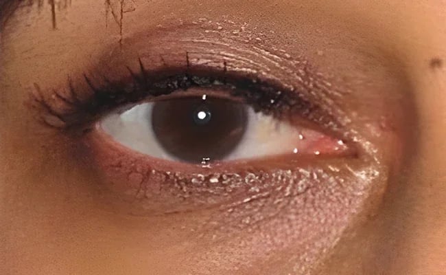 Eyelid Surgery after surgery – Murrieta Facial Plastic Surgery, case 18