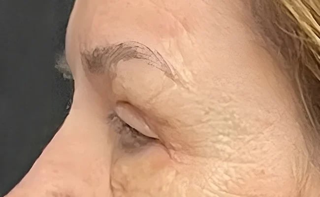 Eyelid Surgery after surgery – Murrieta Facial Plastic Surgery, case 4