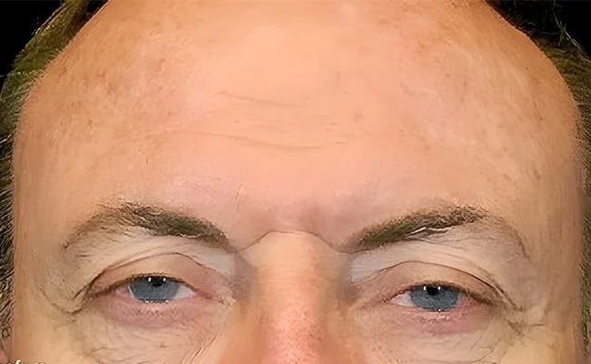 Brow Lift before surgery – Murrieta Facial Plastic Surgery, case 4