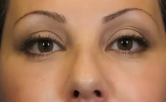 Facelift before surgery – Murrieta Facial Plastic Surgery, case 20