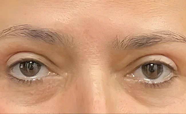 Eyelid Surgery after surgery – Murrieta Facial Plastic Surgery, case 1