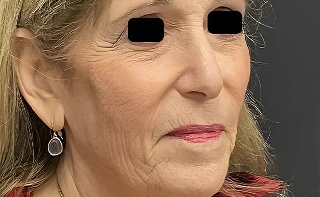 Brow Lift before surgery – Murrieta Facial Plastic Surgery, case 7