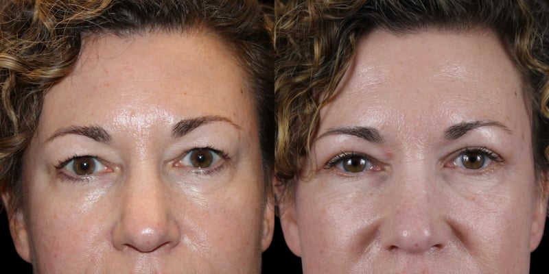 Blepharoplasty before-and-after composite, Consona Plastic Surgery – case 3, view 1
