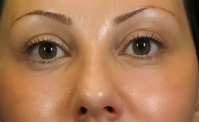 Facelift after surgery – Murrieta Facial Plastic Surgery, case 20