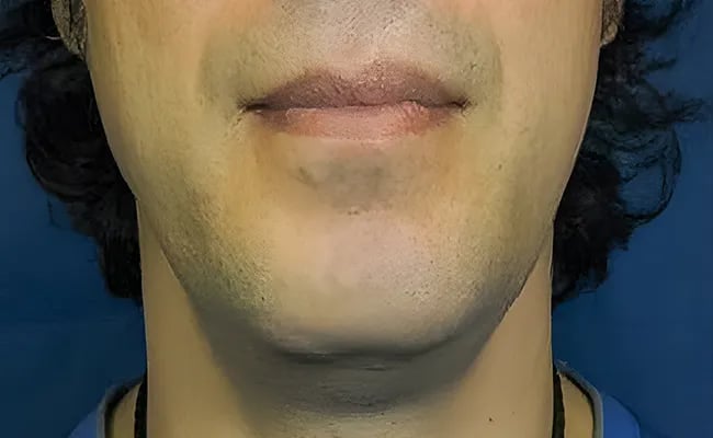 Chin Augmentation before surgery – Murrieta Facial Plastic Surgery, case 6