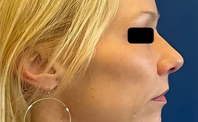 Rhinoplasty after surgery – Murrieta Facial Plastic Surgery, case 6