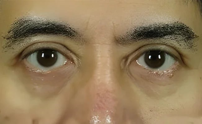 Eyelid Surgery after surgery – Murrieta Facial Plastic Surgery, case 23
