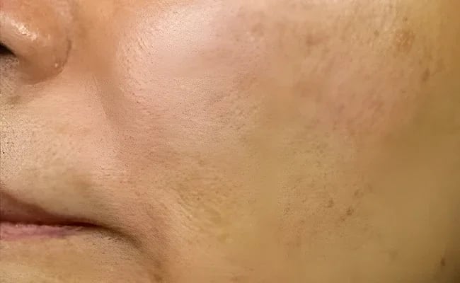 Facial Fat Grafting after surgery – Murrieta Facial Plastic Surgery, case 3
