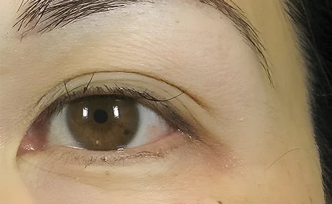 Eyelid Surgery before surgery – Murrieta Facial Plastic Surgery, case 5