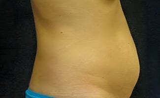 Liposuction before surgery – Murrieta Facial Plastic Surgery, case 1