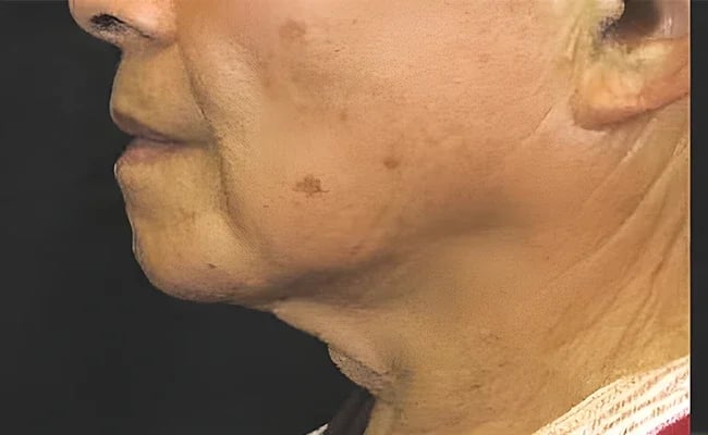 Facelift before surgery – Murrieta Facial Plastic Surgery, case 17
