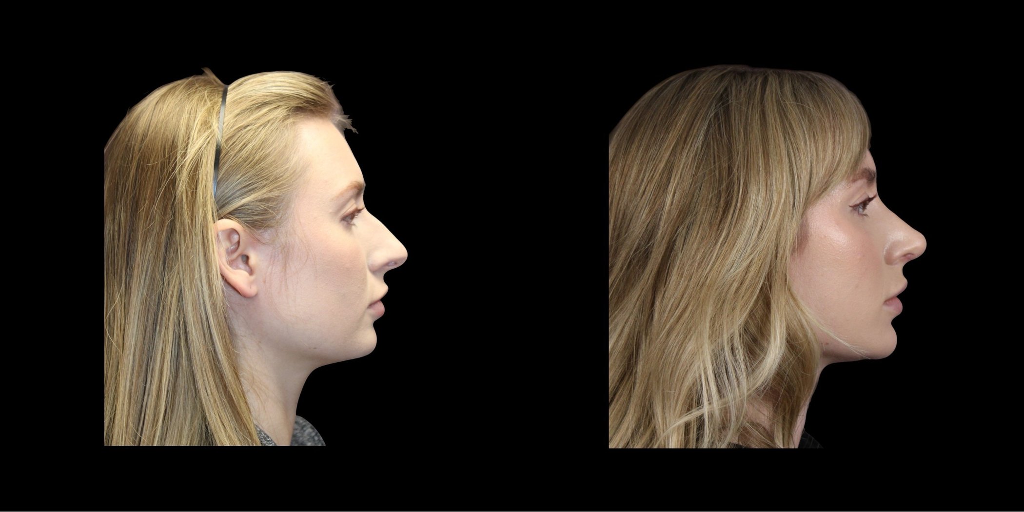 Rhinoplasty before-and-after composite, Consona Plastic Surgery – case 7, view 2