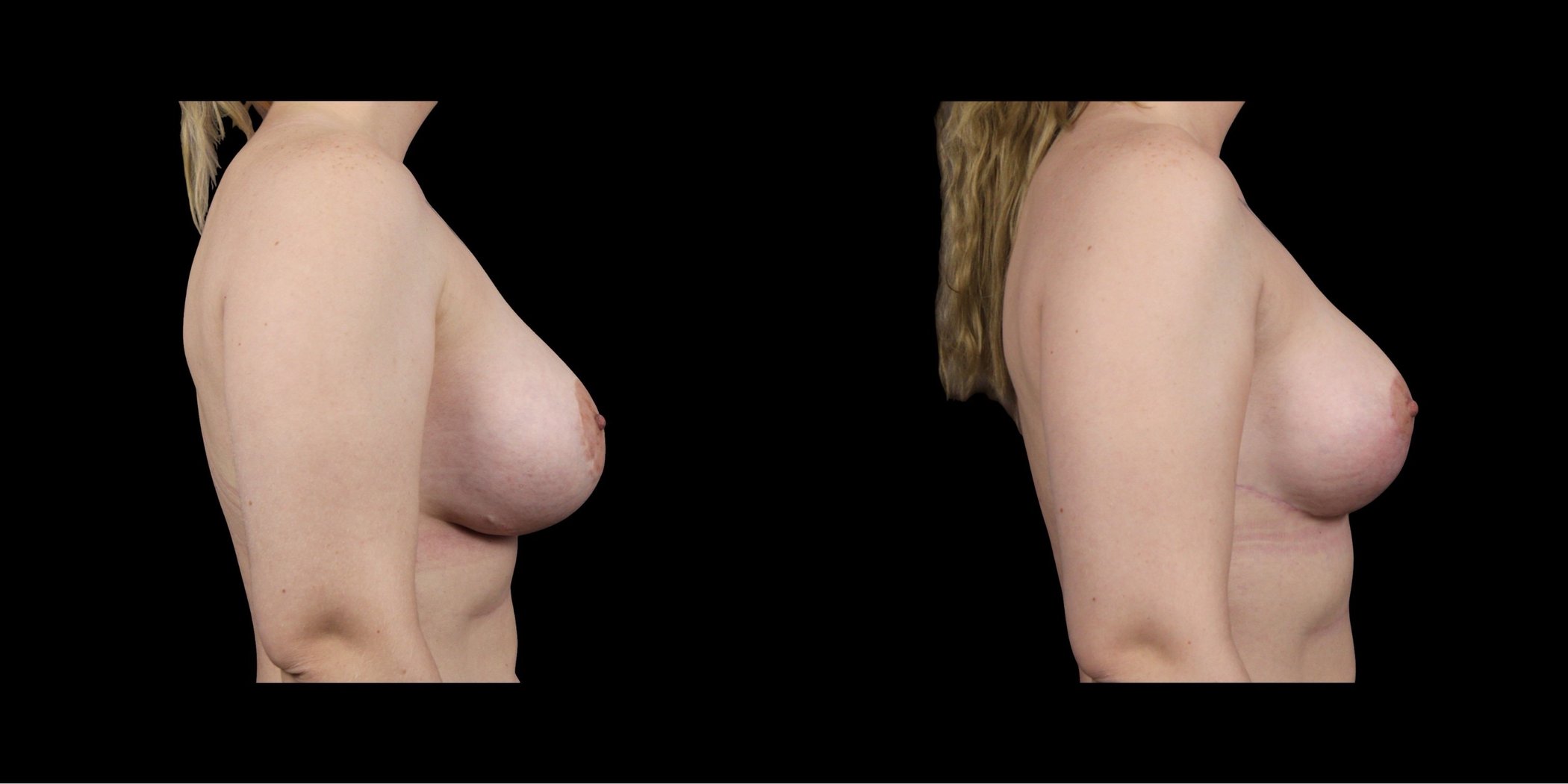 Augmentation Mastopexy before-and-after composite, Consona Plastic Surgery – case 3, view 3