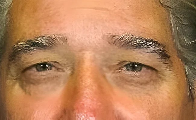 Eyelid Surgery before surgery – Murrieta Facial Plastic Surgery, case 8