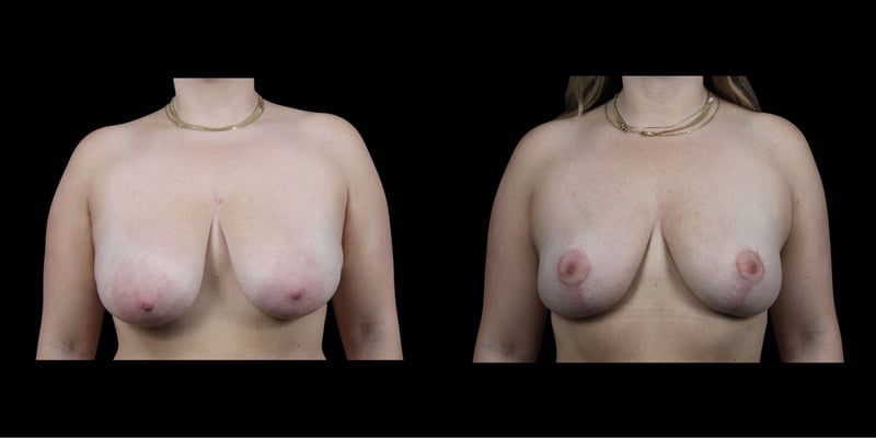Breast Lift before-and-after composite, Consona Plastic Surgery – case 2, view 1
